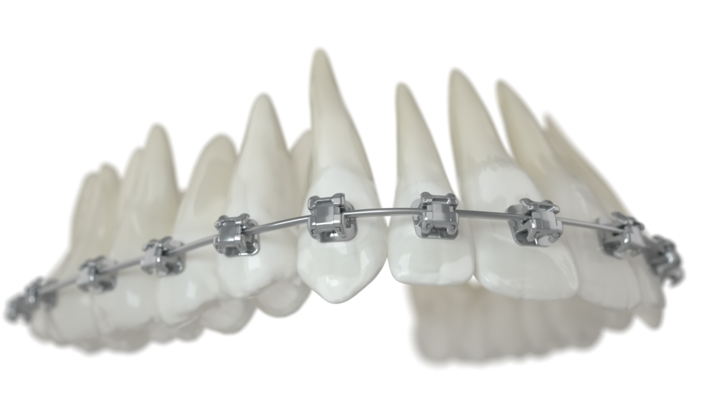 Les soins d’orthodontie obb damon