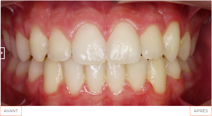 OBB Etudecas 01apres