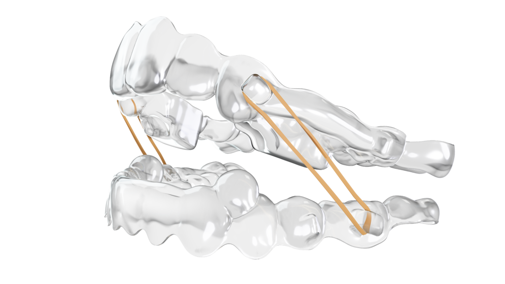 Les soins d’orthodontie spark bitesync upperlower elastic