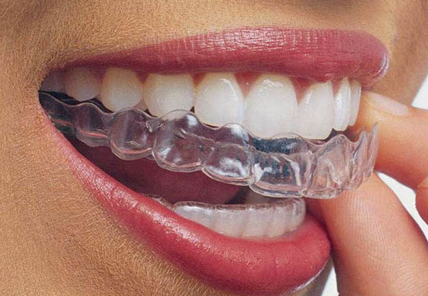 Les soins d’orthodontie contention aligneur (photo)