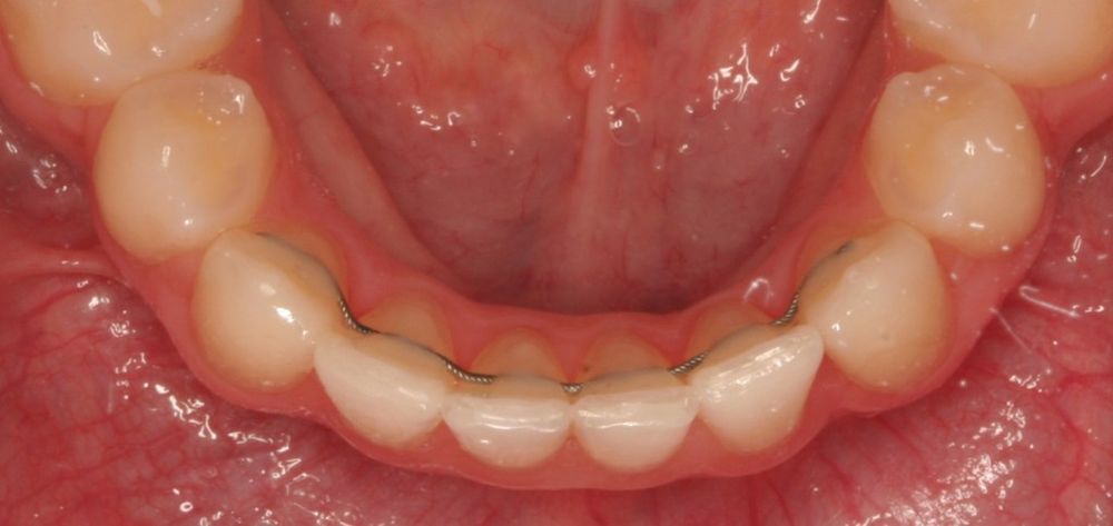 Les soins d’orthodontie contention gouttiere