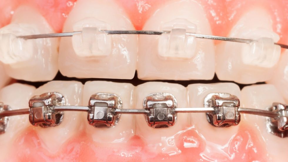 Les soins d’orthodontie traitement appareildentaire